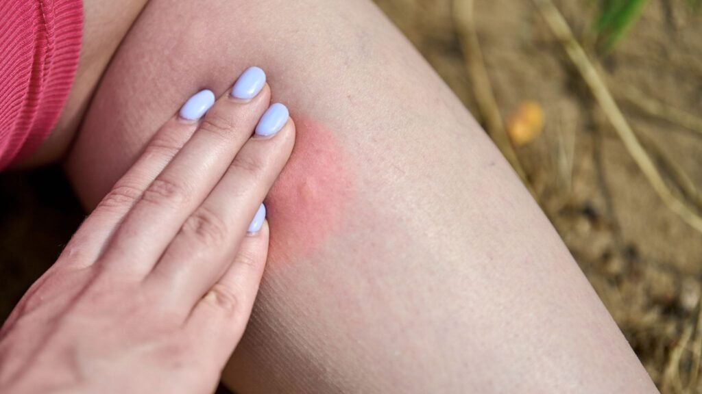 Picada de maruim gera irritação e desconforto. (Foto: Travelarium via Canva)