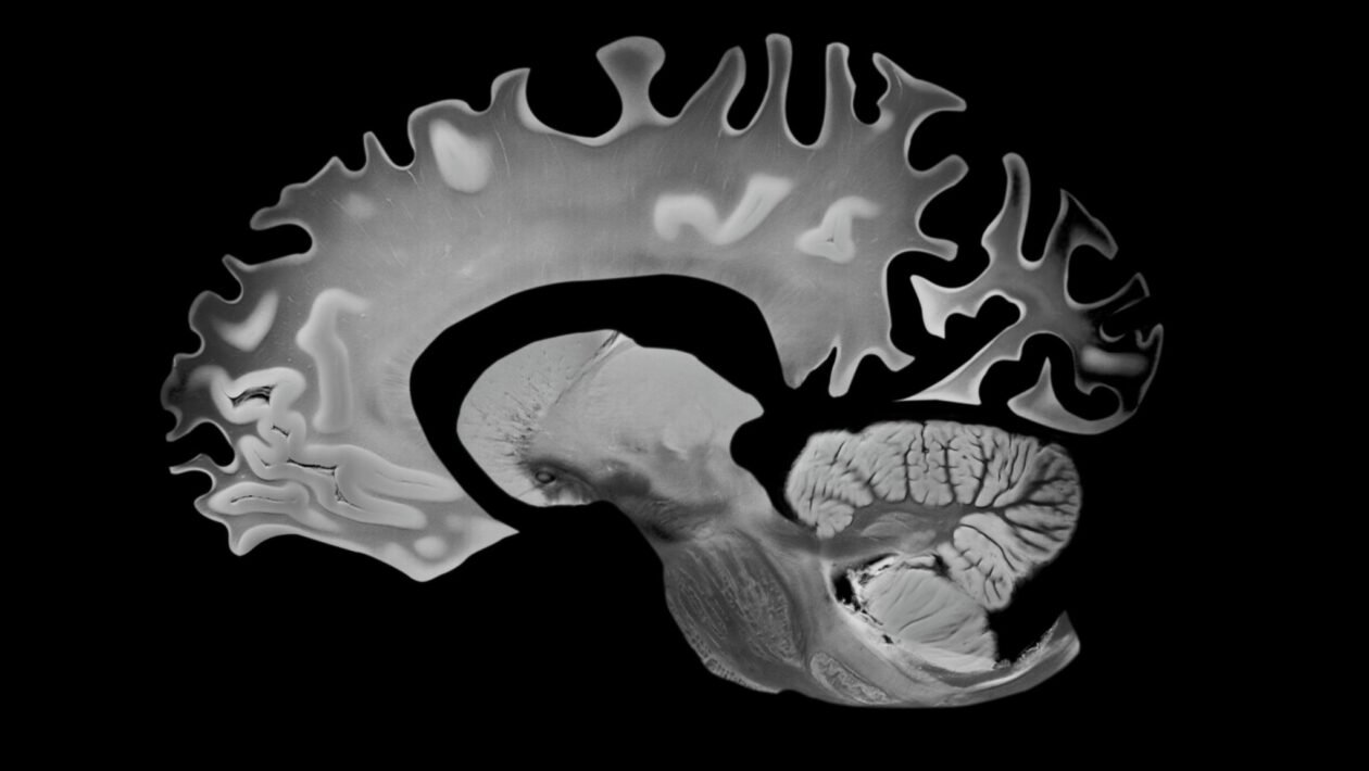 Corte lateral do cérebro evidenciando a atrofia associada ao Alzheimer. (Foto: VA via Canva)