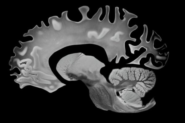 Corte lateral do cérebro evidenciando a atrofia associada ao Alzheimer. (Foto: VA via Canva)
