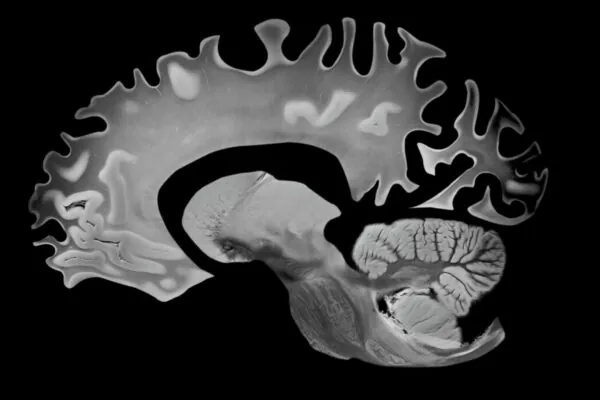 Corte lateral do cérebro evidenciando a atrofia associada ao Alzheimer. (Foto: VA via Canva)