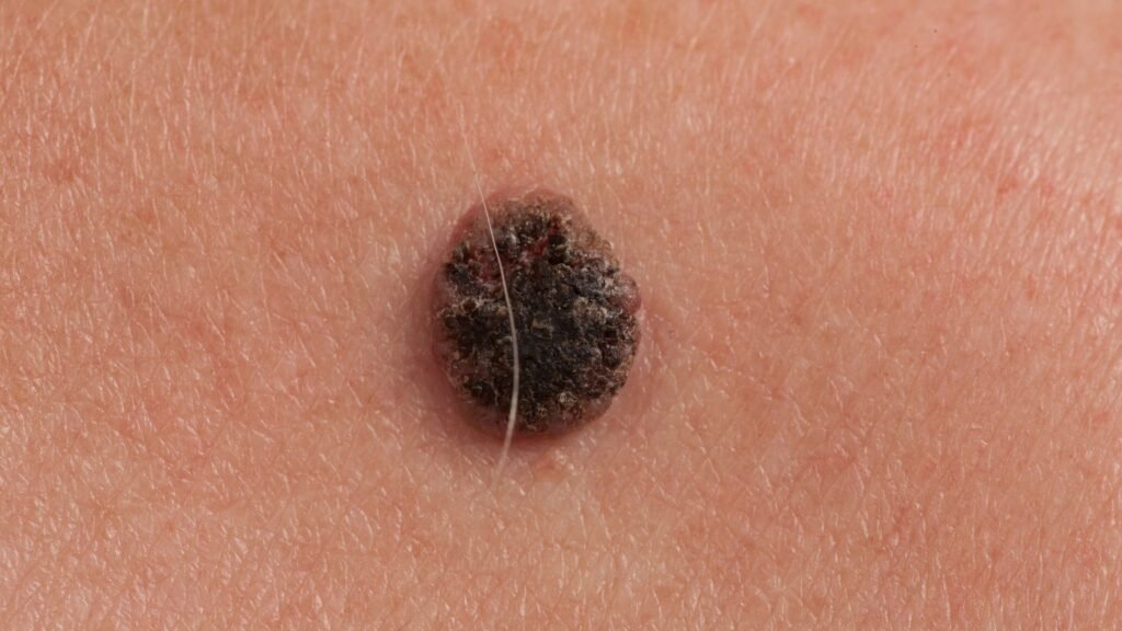 Melanoma usa proteína para driblar o sistema imune. (Foto: Getty Images via Canva)