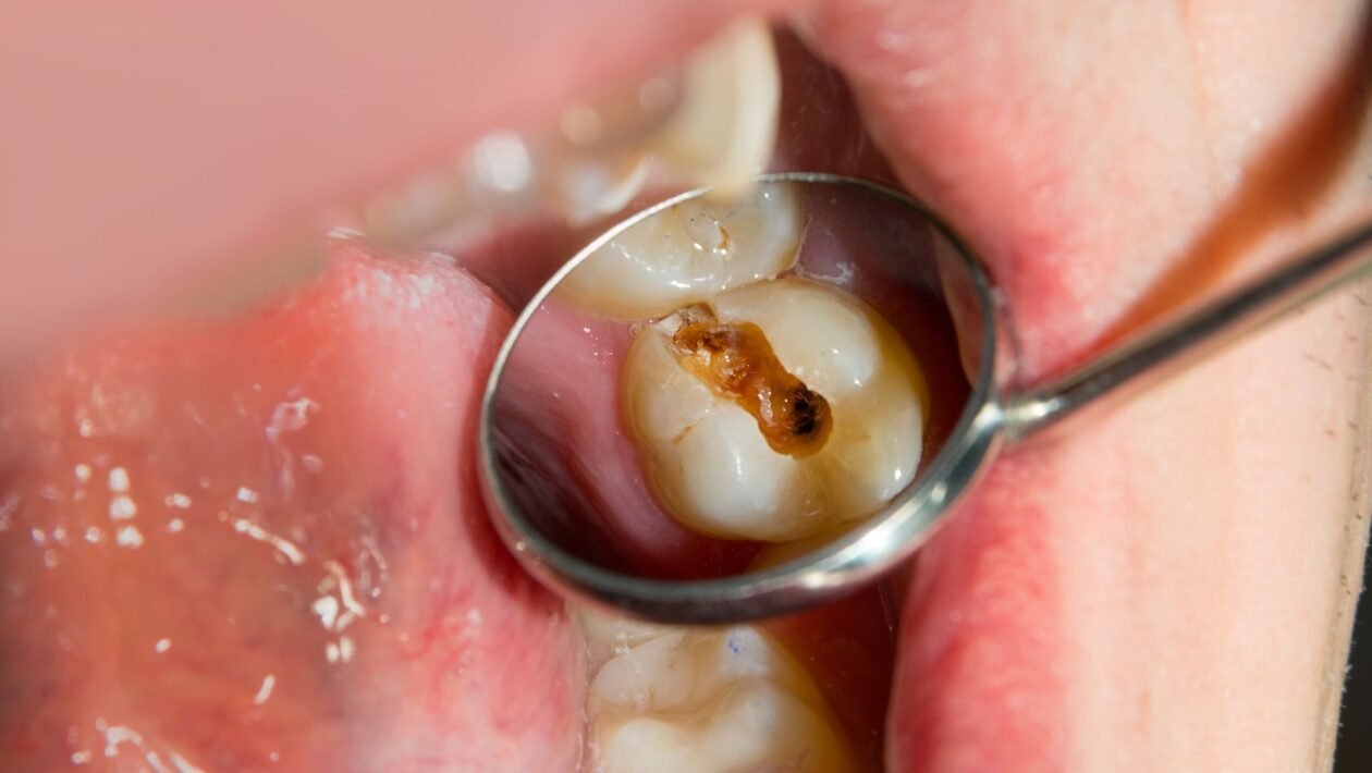 Solução combate acidez e previne cáries dentárias. (Foto: Getty Images via Canva)