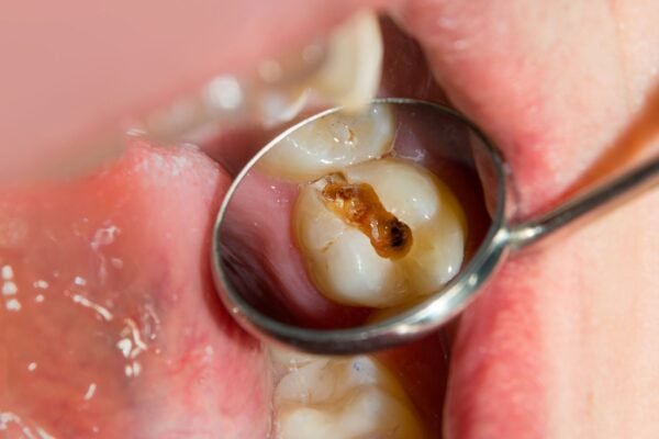 Solução combate acidez e previne cáries dentárias. (Foto: Getty Images via Canva)