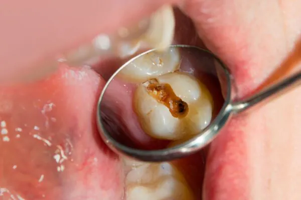 Solução combate acidez e previne cáries dentárias. (Foto: Getty Images via Canva)