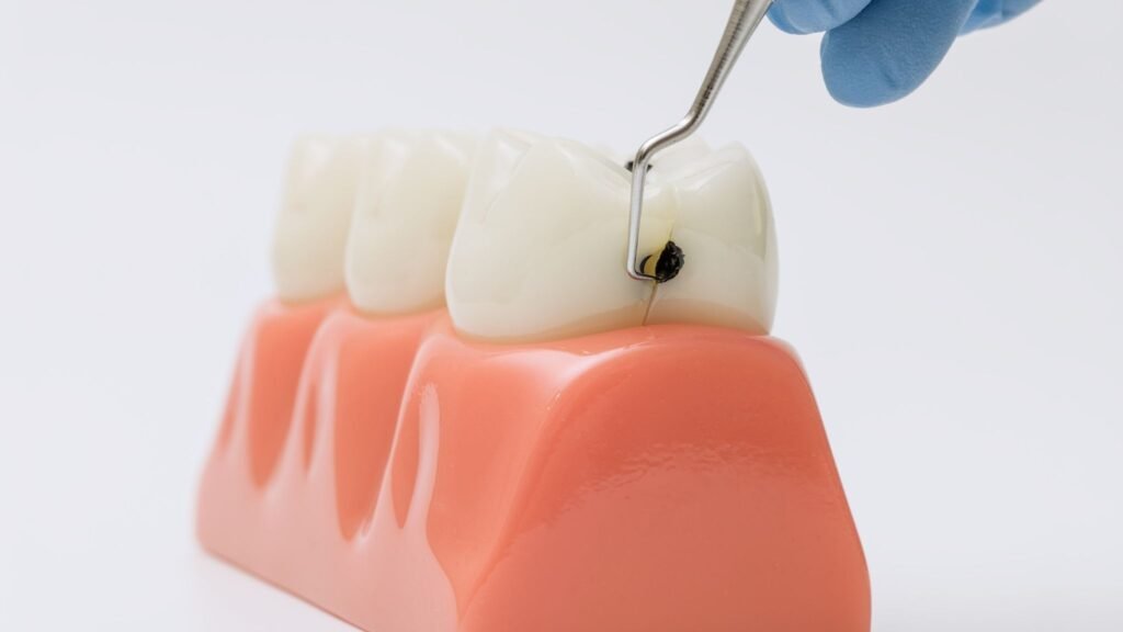 Saliva artificial protege dentes contra cáries. (Foto: Maximusnd Zahar via Canva)