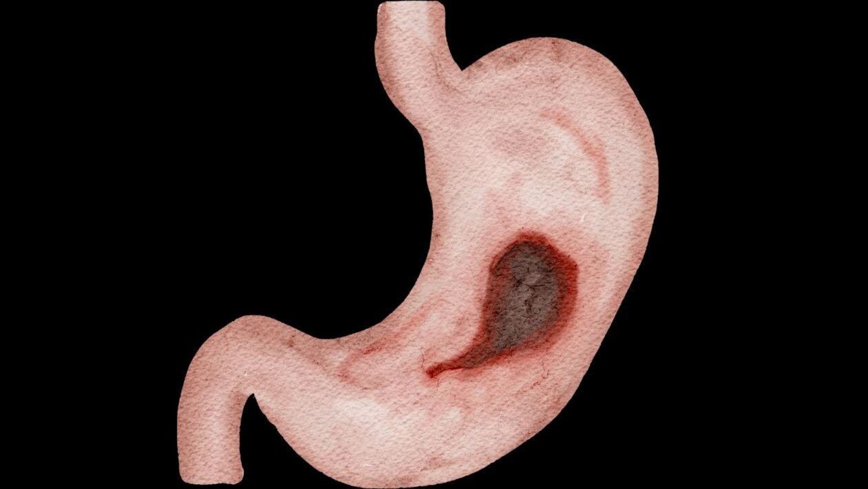 Suco gástrico pode ajudar a detectar câncer. (Foto: Reni Andriawati via Canva)