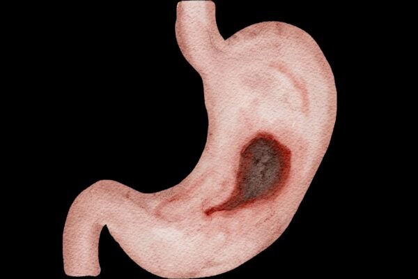 Suco gástrico pode ajudar a detectar câncer. (Foto: Reni Andriawati via Canva)