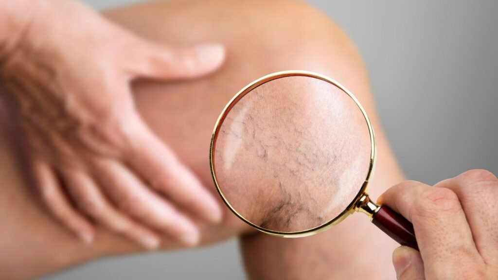 Vitamina D reduz estresse oxidativo nas veias. (Foto: Getty Images via Canva)