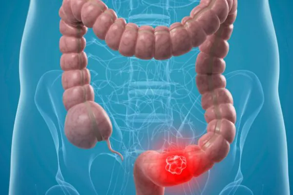 Rastreamento no SUS amplia prevenção do câncer intestinal. (Foto: Science Photo Library via Canva)