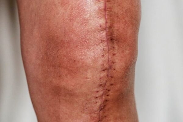 cirurgia de menisco