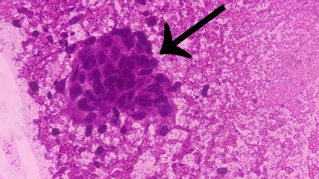 Células tumorais e inflamação no câncer de pulmão. (Foto: Getty Images via Canva)