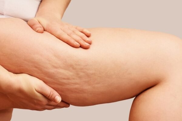 Lipedema causa dor e não é só estética. (Getty Images via Canva)