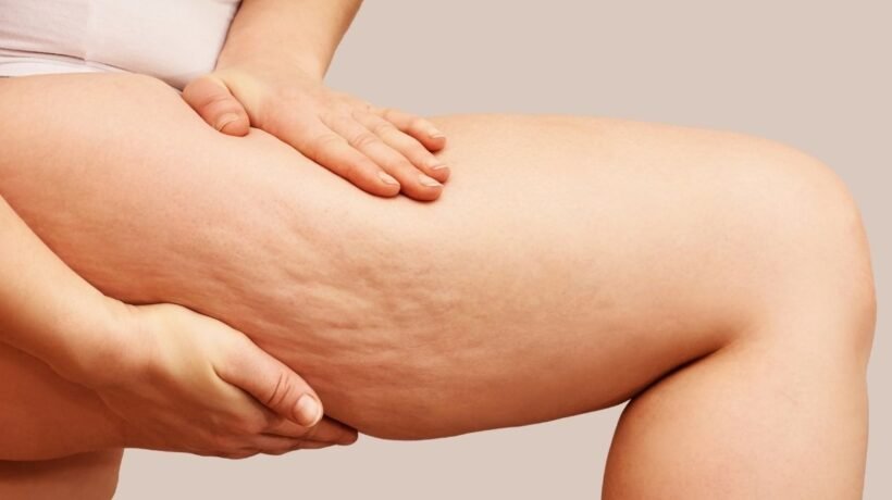 Lipedema causa dor e não é só estética. (Getty Images via Canva)
