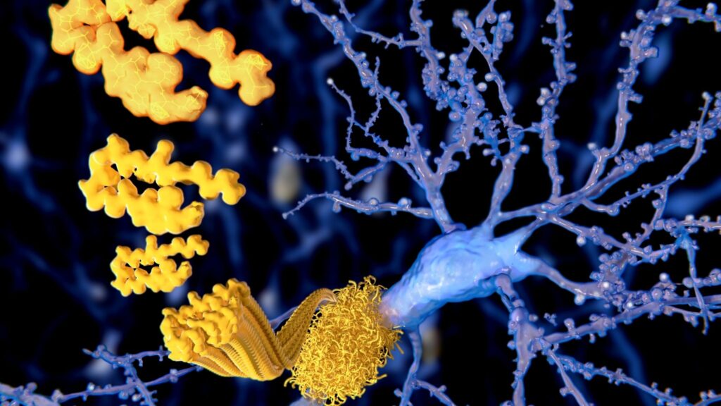 Placas de beta-amiloide geram radicais livres e matam neurônios. (Foto: Getty Images via Canva)