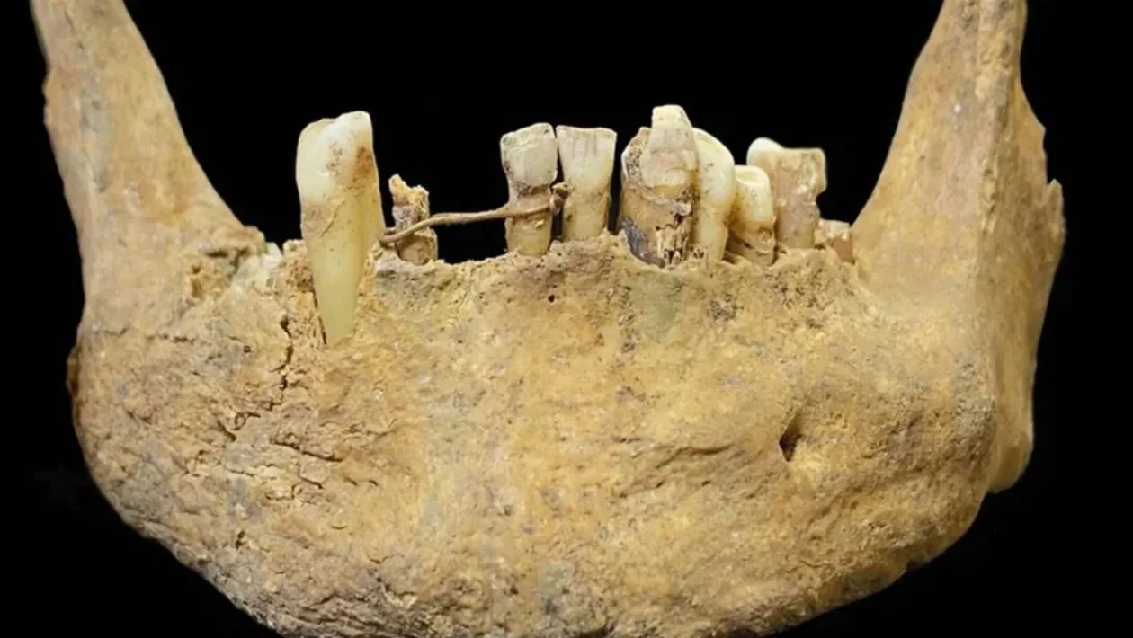 Mandíbula medieval revelou ponte dentária de ouro usada há cerca de 500 anos. (Imagem: Divulgação/Jenna Dittmar)