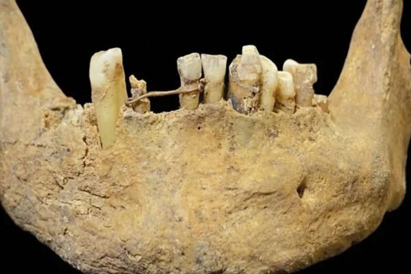 Mandíbula medieval revelou ponte dentária de ouro usada há cerca de 500 anos. (Imagem: Divulgação/Jenna Dittmar)