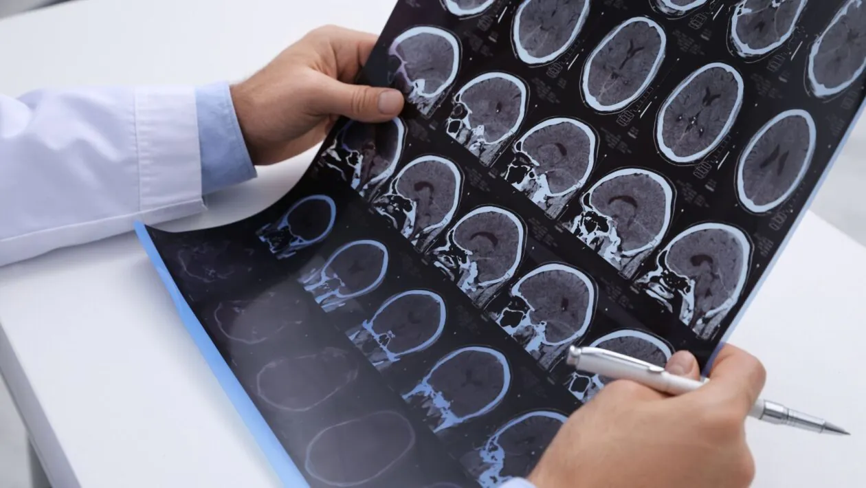 Diagnóstico precoce melhora controle da esclerose múltipla. (Foto: Getty Images via Canva)