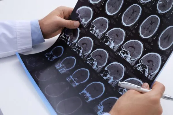Diagnóstico precoce melhora controle da esclerose múltipla. (Foto: Getty Images via Canva)