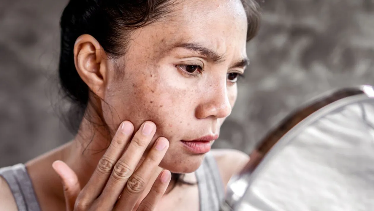 Hormônios podem influenciar o surgimento do melasma. (Foto: Doucefleur's Images via Canva)
