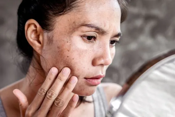 Hormônios podem influenciar o surgimento do melasma. (Foto: Doucefleur's Images via Canva)