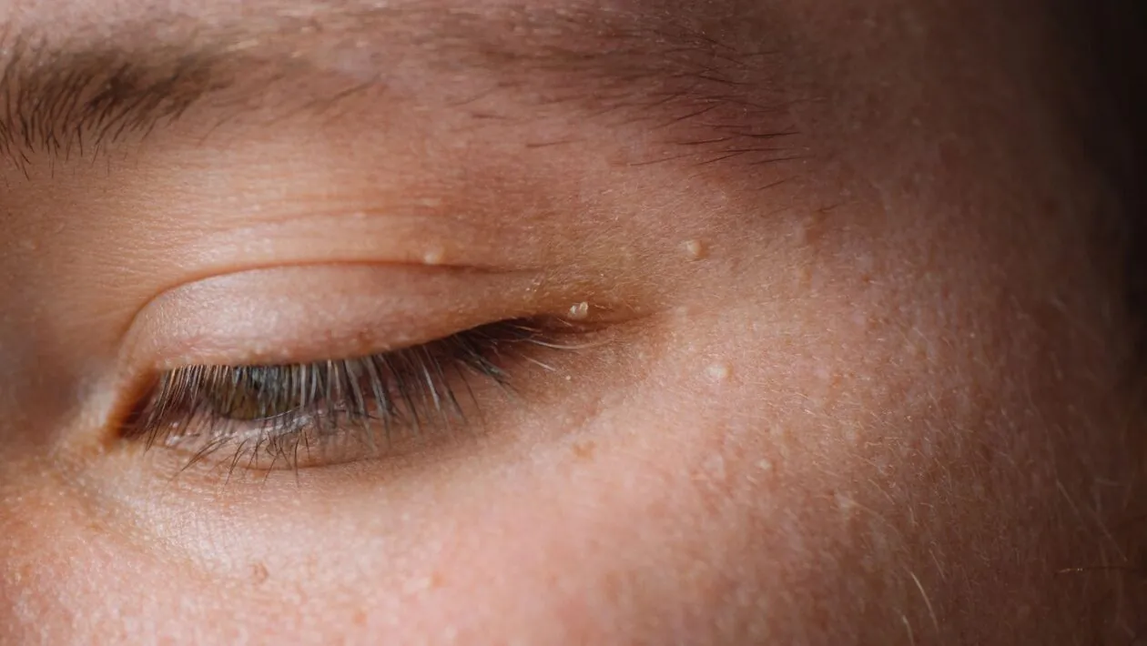 Bolinhas brancas no rosto não são acne nem inflamação. (Foto: Getty Images via Canva)