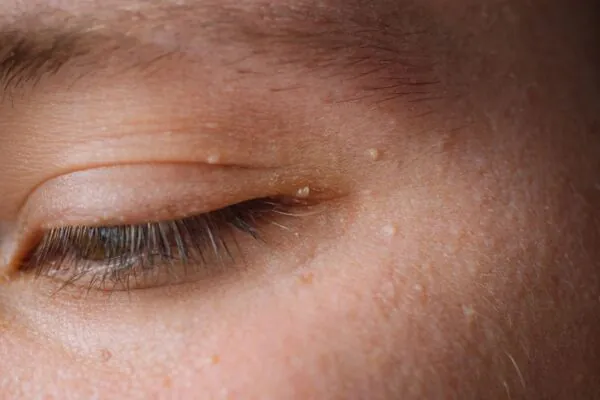 Bolinhas brancas no rosto não são acne nem inflamação. (Foto: Getty Images via Canva)