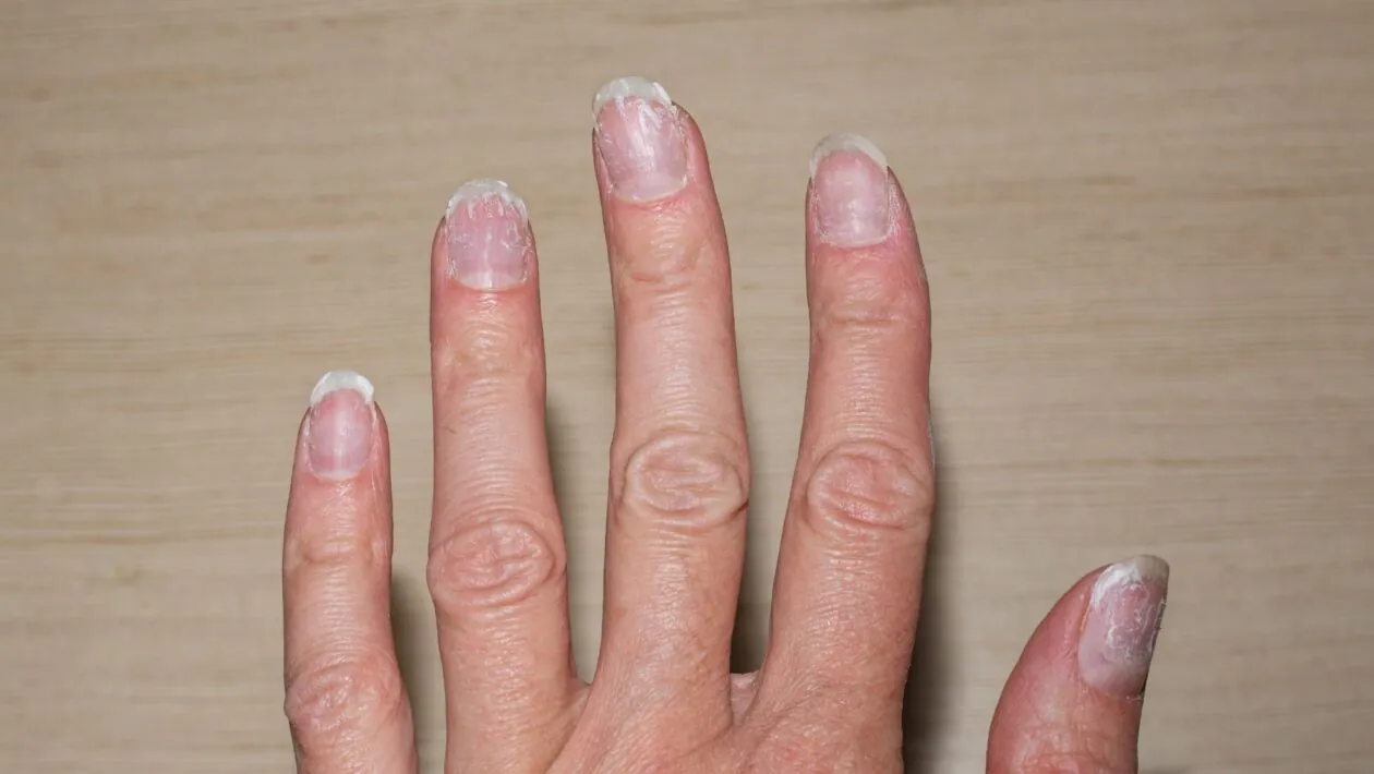 Deficiência de ferro afeta crescimento das unhas. (Foto: Getty Images via Canva)