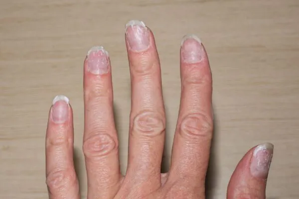 Deficiência de ferro afeta crescimento das unhas. (Foto: Getty Images via Canva)