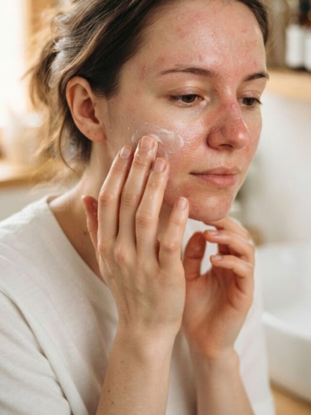 9 passos para acalmar a dermatite seborreica no rosto