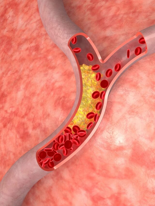 Colesterol LDL: por que ele é chamado de “ruim”?