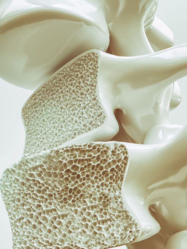 O que é osteoporose e por que os ossos ficam frágeis?
